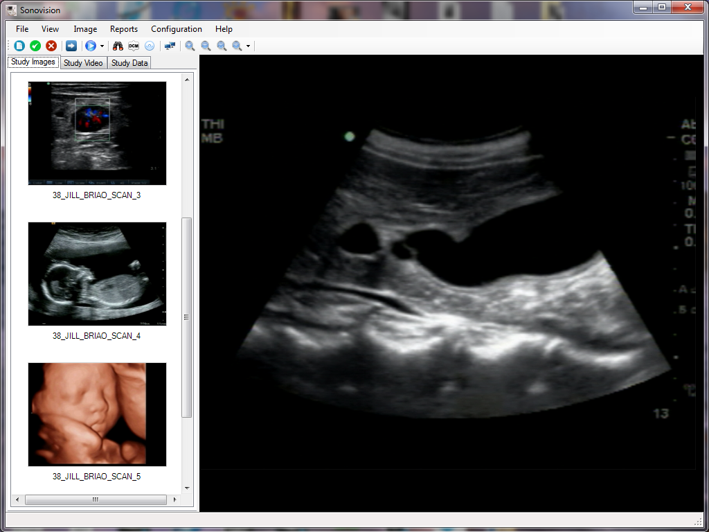 Ultrasound Images Capturing Screen