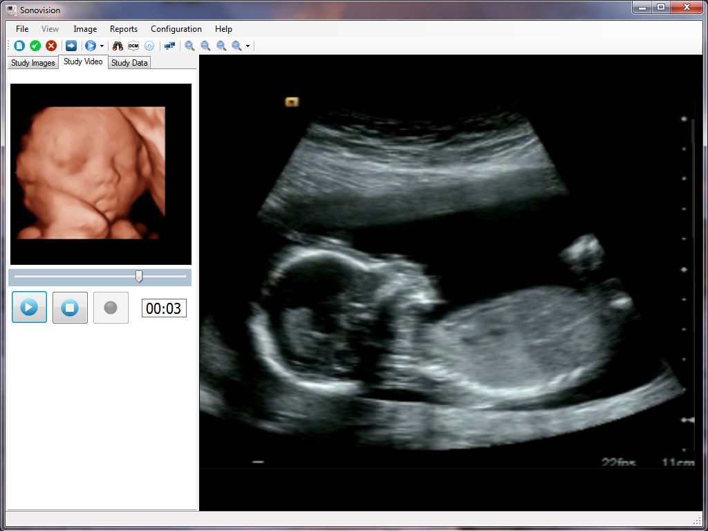 Ultrasound Video Recording Screen